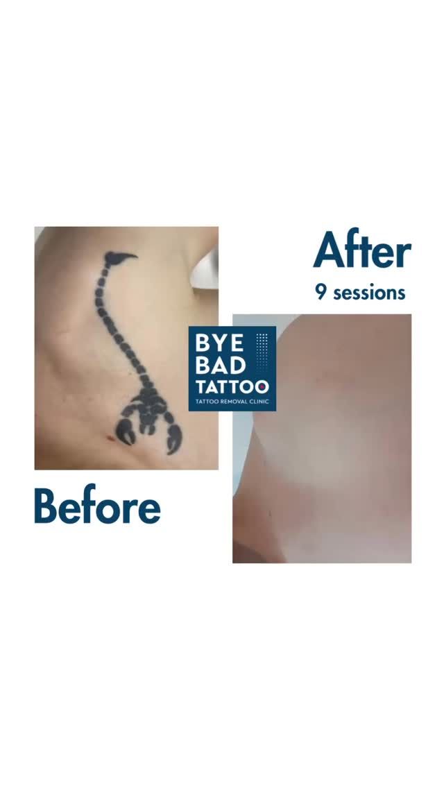 Découvrez les étapes de ce détatouage ⏩️

En 9 séances de laser Picoseconde, ce client a retrouvé une peau neuve 🦂👋

Effacez votre tatouage en toute sécurité à prix accessible avec Bye Bad Tattoo 🪄

Devis en ligne en quelques clics 📲

#detatouage #tattooremoval #lasertattooremoval #detatouagesuisse #badtattoos #byebadtattoo #newskin #newlife #picoway