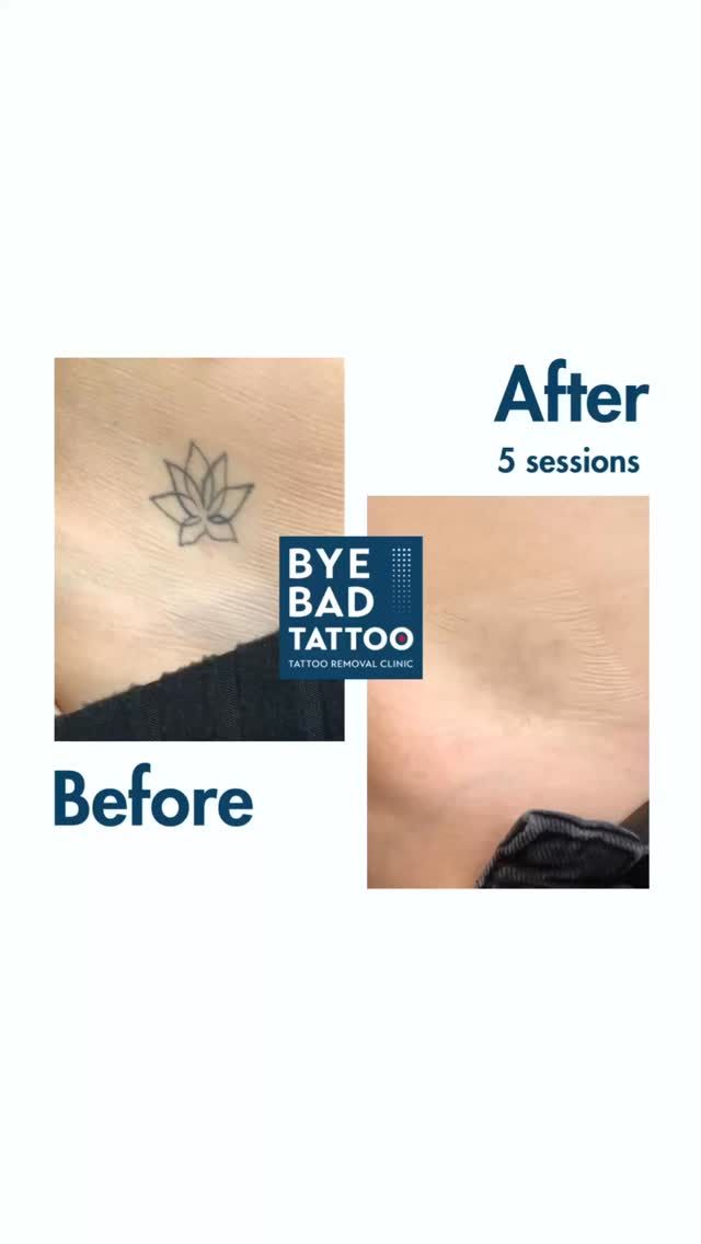 Le nombre de séances pour effacer votre tatouage dépendra de nombreux facteurs extérieurs comme le type d’encre utilisé et sa profondeur d’implantation.
👉 Découvrez ici un avant / après 5 séances sur un tatouage aux lignes fines et peu profond.

#detatouage #tattooremoval #lasertattooremoval #detatouagesuisse #badtattoos #byebadtattoo #newskin #newlife #picoway